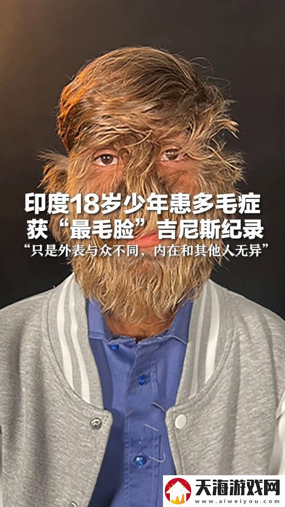 印度少年获“最毛脸”吉尼斯纪录
